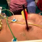 Matan a un hombre de un flechazo en el corazón en Italia por hacer ruido Matan a un hombre de un flechazo en el corazón en Italia por hacer ruido