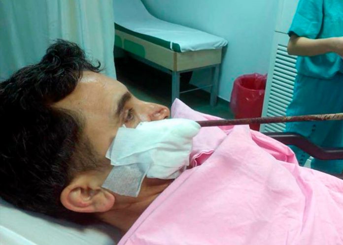 ¡Milagro en Turquía! Barra de acero le quedó a centímetros del cerebro