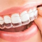 ¿Qué es Invisalign? Te diremos las ventajas de esta nueva moda ¿Qué es Invisalign? Te diremos las ventajas de esta nueva moda