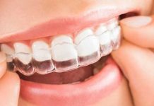 ¿Qué es Invisalign? Te diremos las ventajas de esta nueva moda