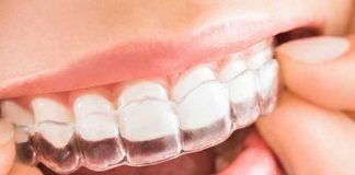 ¿Qué es Invisalign? Te diremos las ventajas de esta nueva moda