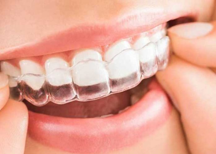 w ¿Qué es Invisalign? Te diremos las ventajas de esta nueva moda