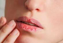 Labios resecos: ¿Por qué pasa y qué hacer? Labios resecos: ¿Por qué pasa y qué hacer?