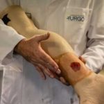 Crean piel artificial para cicatrizar las quemaduras graves Crean piel artificial para cicatrizar las quemaduras graves