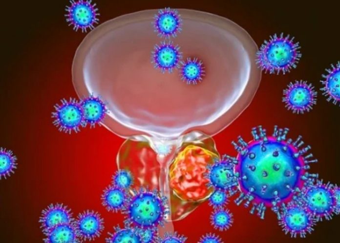 5 indicios de que padeces cáncer de próstata