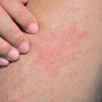 La picazón en la piel podría ser una señal del cáncer
