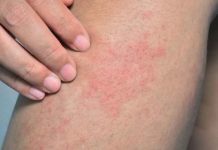La picazón en la piel podría ser una señal del cáncer La picazón en la piel podría ser una señal del cáncer