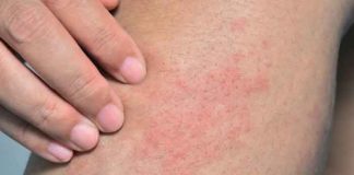 La picazón en la piel podría ser una señal del cáncer
