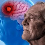 Nuevo tratamiento para el Alzheimer es autorizado por EE.UU. EE.UU. autoriza nuevo tratamiento para la enfermedad de Alzheimer