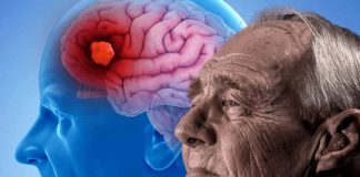 EE.UU. autoriza nuevo tratamiento para la enfermedad de Alzheimer