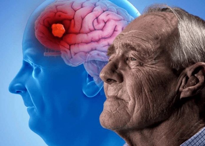 EE.UU. autoriza nuevo tratamiento para la enfermedad de Alzheimer