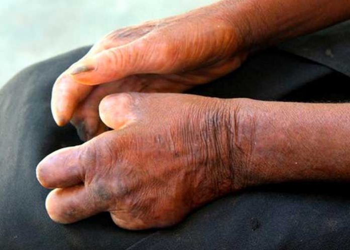 lepra La lepra está controlada en la República Dominicana