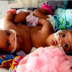 25 médicos logran separación de siamesas tras innovadora cirugía en Texas 25 médicos logran separación de siamesas tras innovadora cirugía en Texas