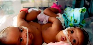 25 médicos logran separación de siamesas tras innovadora cirugía en Texas