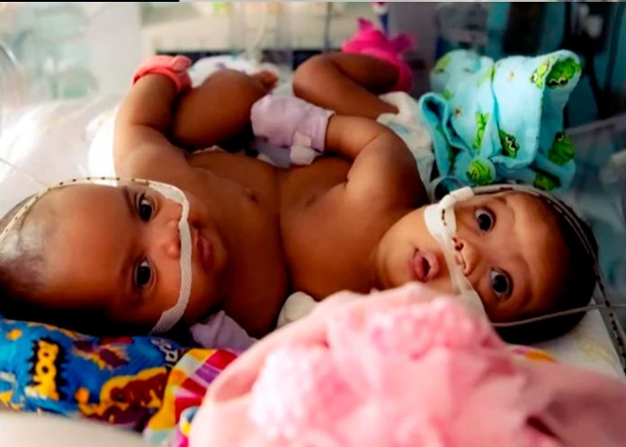 25 médicos logran separación de siamesas tras innovadora cirugía en Texas