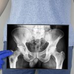 Chavalo se introduce objeto extraño por el "chiquito" y termina en el hospital