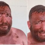 Se quiso broncear para una cita pero se quedó dormido 