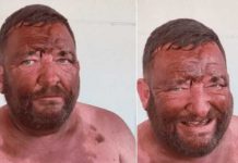 «Quería ir guapo el pobre» Se broncea para una cita y terminó de color naranja Se quiso broncear para una cita pero se quedó dormido
