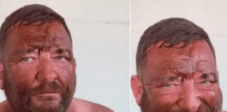 Se quiso broncear para una cita pero se quedó dormido 