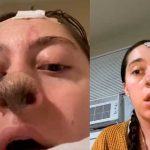 Perro le muerde la nariz a una chavala y ahora le crece pelo en esa parte