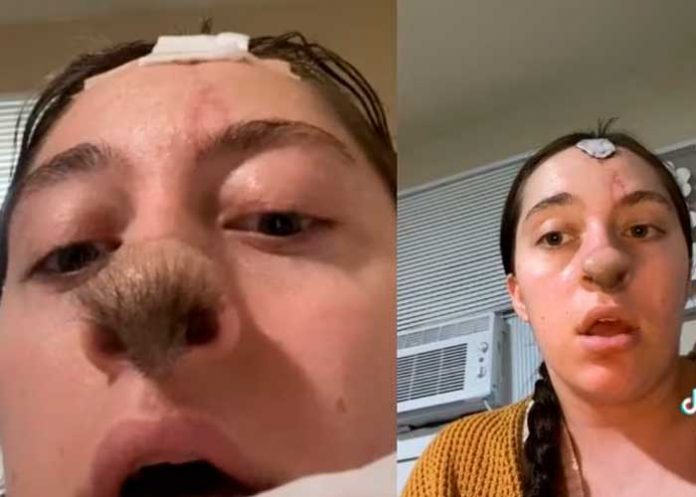 3 Perro le muerde la nariz a una chavala y ahora le crece pelo en esa parte