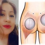 Soñaba con glúteos de impacto, se puso implantes y «quedó como monstruo» Soñaba con gluteos de impacto y quedó fatal
