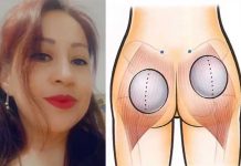 Soñaba con glúteos de impacto, se puso implantes y «quedó como monstruo» Soñaba con gluteos de impacto y quedó fatal