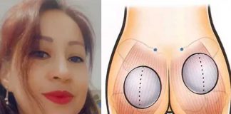 Soñaba con gluteos de impacto y quedó fatal