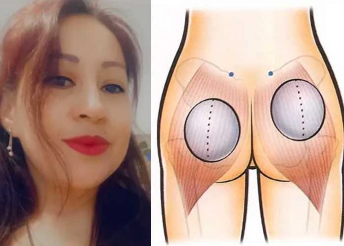 Soñaba con gluteos de impacto y quedó fatal