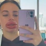 ¡Caballada! Chavala se inyecta ácido hialurónico en los labios y queda "trompuda"