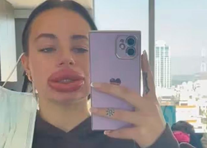 1 ¡Caballada! Chavala se inyecta ácido hialurónico en los labios y queda