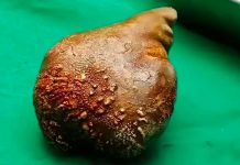 Impactante: Extirpan la piedra de riñón más pesada y grande del mundo Extirpan la piedra de riñón más pesada y grande del mundo