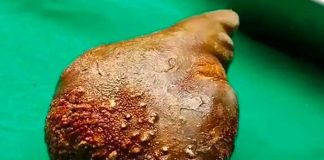 Extirpan la piedra de riñón más pesada y grande del mundo