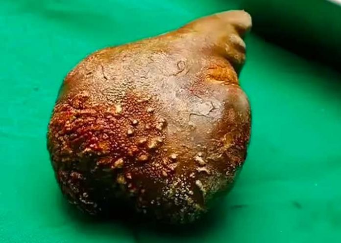 piedra Extirpan la piedra de riñón más pesada y grande del mundo