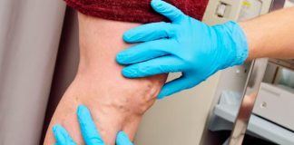Puedes estar sufriendo de una trombosis profunda y no lo sabés