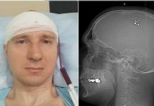 Se hizo cirugía cerebral perforando el cráneo «para controlar los sueños» Se hizo cirugía cerebral perforando el cráneo "para controlar los sueños"