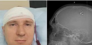 Se hizo cirugía cerebral perforando el cráneo "para controlar los sueños"