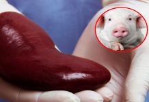 «¡Rompiendo barreras! Riñón de cerdo salva vida humana en trasplante histórico.» "¡Rompiendo barreras! Riñón de cerdo salva vida humana en trasplante histórico."