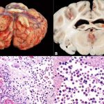 Una persona murió en EE.UU. tras ser infectada por una ameba "comecerebros"