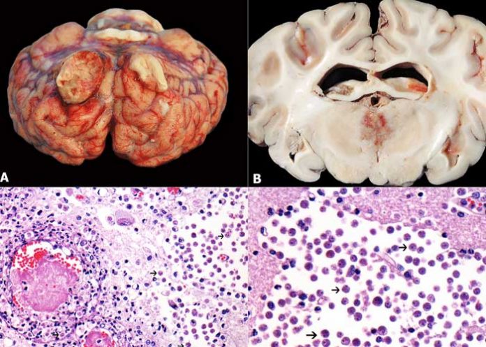Una persona murió en EE.UU. tras ser infectada por una ameba 