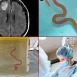 «Sin palabras» Encuentran gusano vivo en el cerebro de una mujer de Australia Encuentran gusano vivo en el cerebro de una mujer