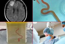 «Sin palabras» Encuentran gusano vivo en el cerebro de una mujer de Australia Encuentran gusano vivo en el cerebro de una mujer