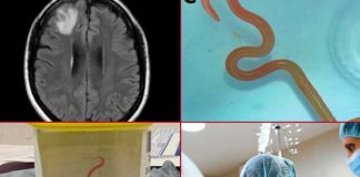 Encuentran gusano vivo en el cerebro de una mujer