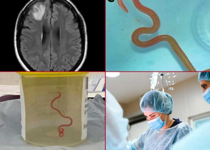 Encuentran gusano vivo en el cerebro de una mujer