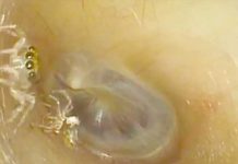 Increíble: Araña sorprende a un médico en el oído de una paciente (Video) Araña sorprende a un médico en el oído de una paciente (Video)