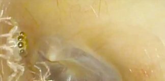 Araña sorprende a un médico en el oído de una paciente (Video)