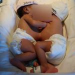 «Si se pudo» Hermanas siamesas son separadas con éxito en un hospital de España Hermanas siamesas son separadas en un hospital de España