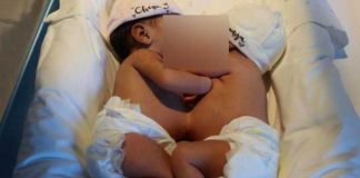 Hermanas siamesas son separadas en un hospital de España