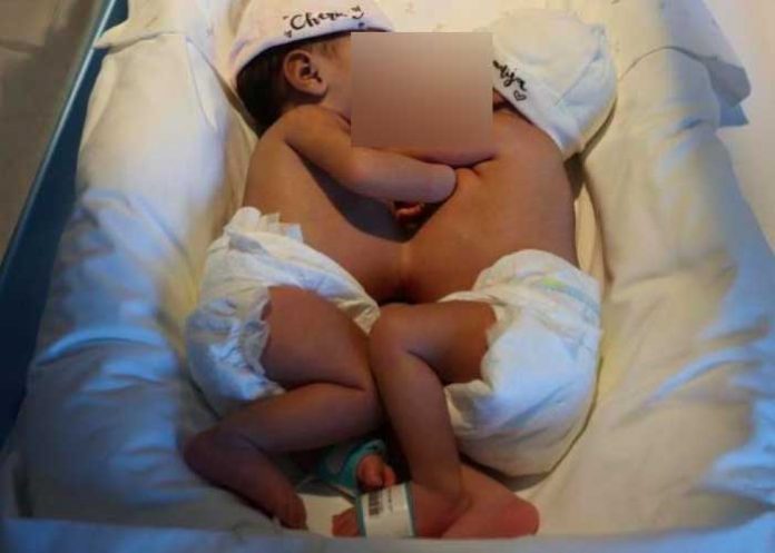 Hermanas siamesas son separadas en un hospital de España