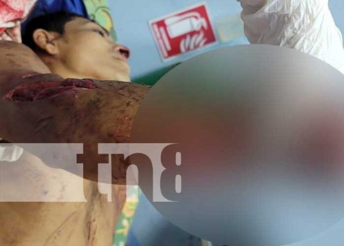 1 El Rama: Con una mano cercenada resultó un hombre en celebración de año nuevo
